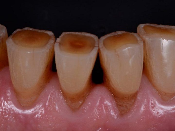 Door tandenknarsen of -klemmen kan je gebit ernstige slijtage oplopen!