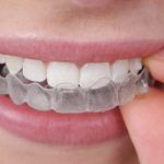 Knarsbitjes zijn bij de tandarts verkrijgbaar om verdere slijtage tegen te gaan